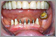 mutilation des dents